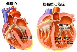 図 DCMと正常