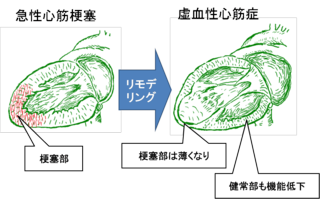 図　梗塞後リモデリング