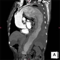 破裂性胸腹部大動脈瘤のCT写真です。体の半分近くが大動脈瘤または出血の血液という恐ろしい状態でした